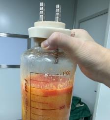 嘉善水动力吸脂手术要做多久？